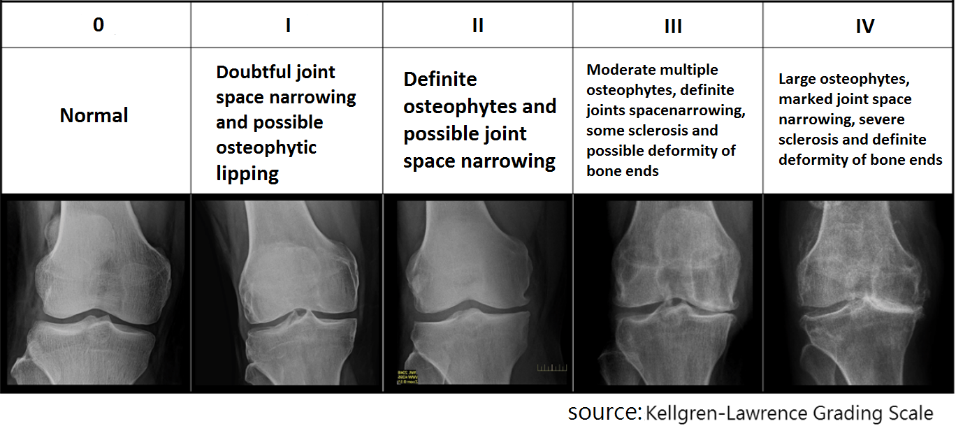 退化性關節炎分級圖(英)